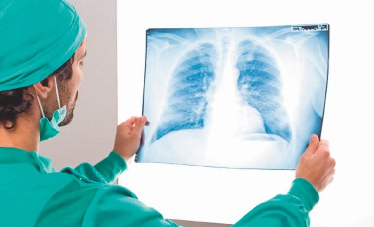 Qué es la fibrosis pulmonar