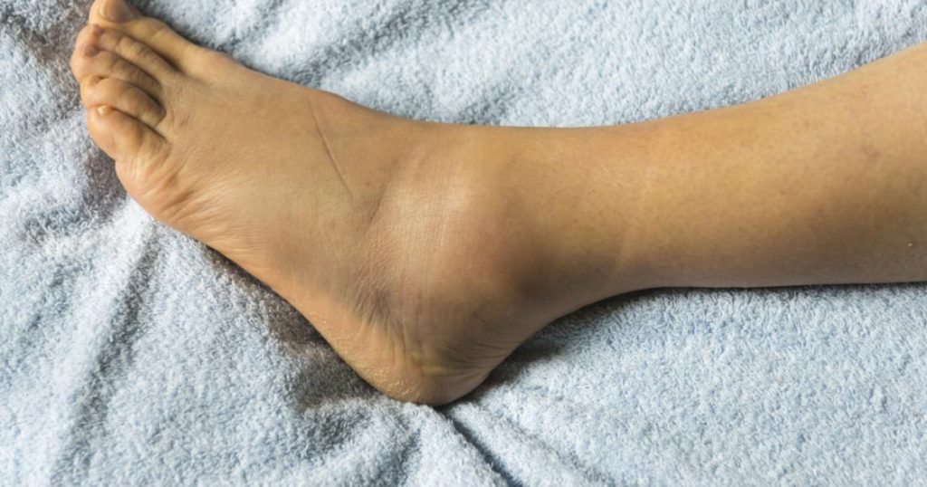 Edema