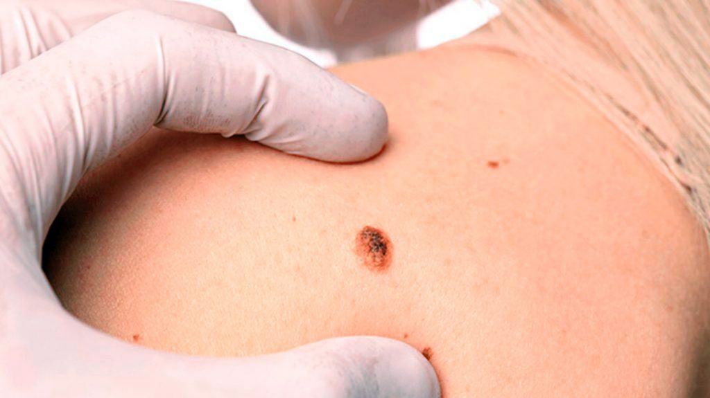 Son Muchos Melanomas Que Causan Estragos Cáncer