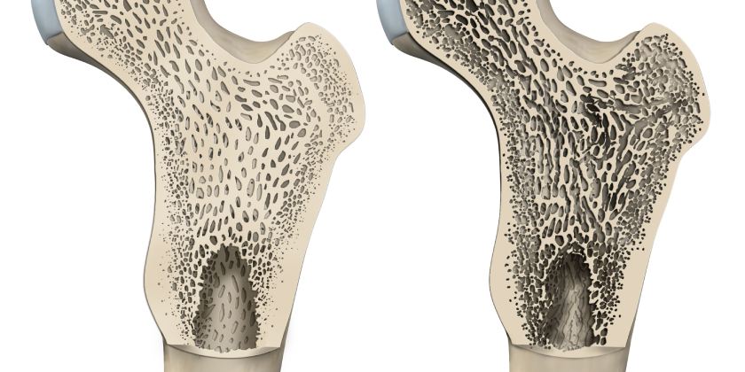 ¿El Aguacate Ayuda A Prevenir La Osteoporosis?
