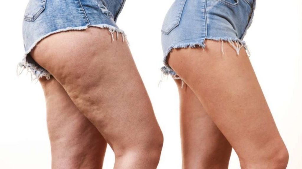 Celulitis: Cómo Tratarla Y Eliminarla De Tu Piel