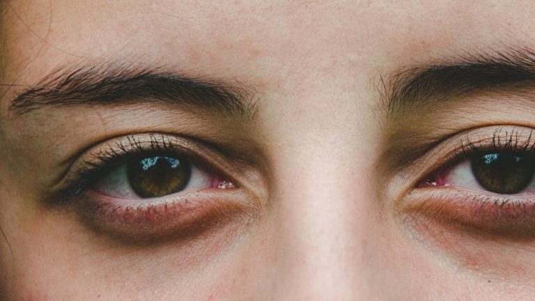 Cómo quitar las ojeras moradas
