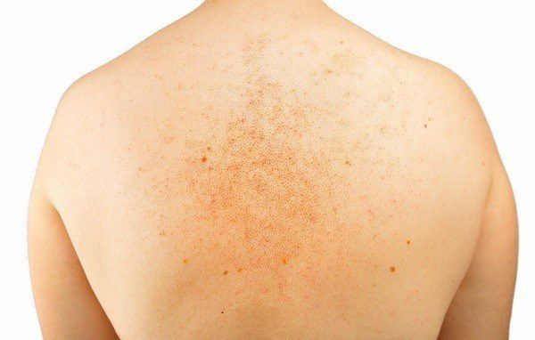 ¿Qué Origina Las Manchas En La Piel?