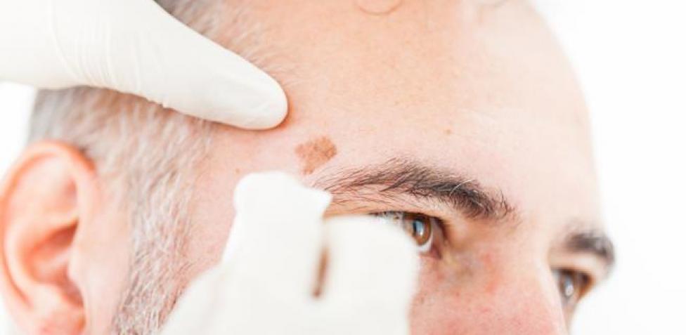 ¿Cómo Eliminar Naturalmente Las Manchas?