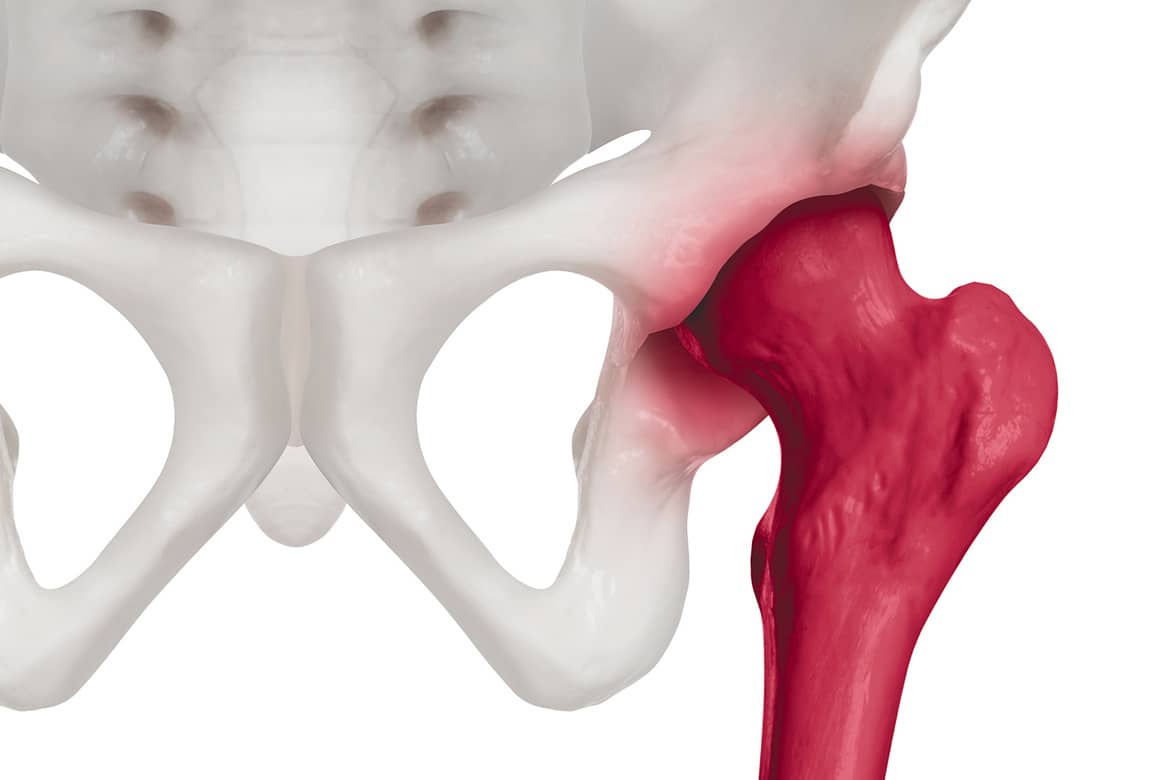 Qué es la artrosis de cadera