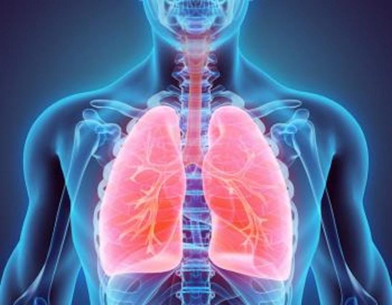Qué es un edema pulmonar