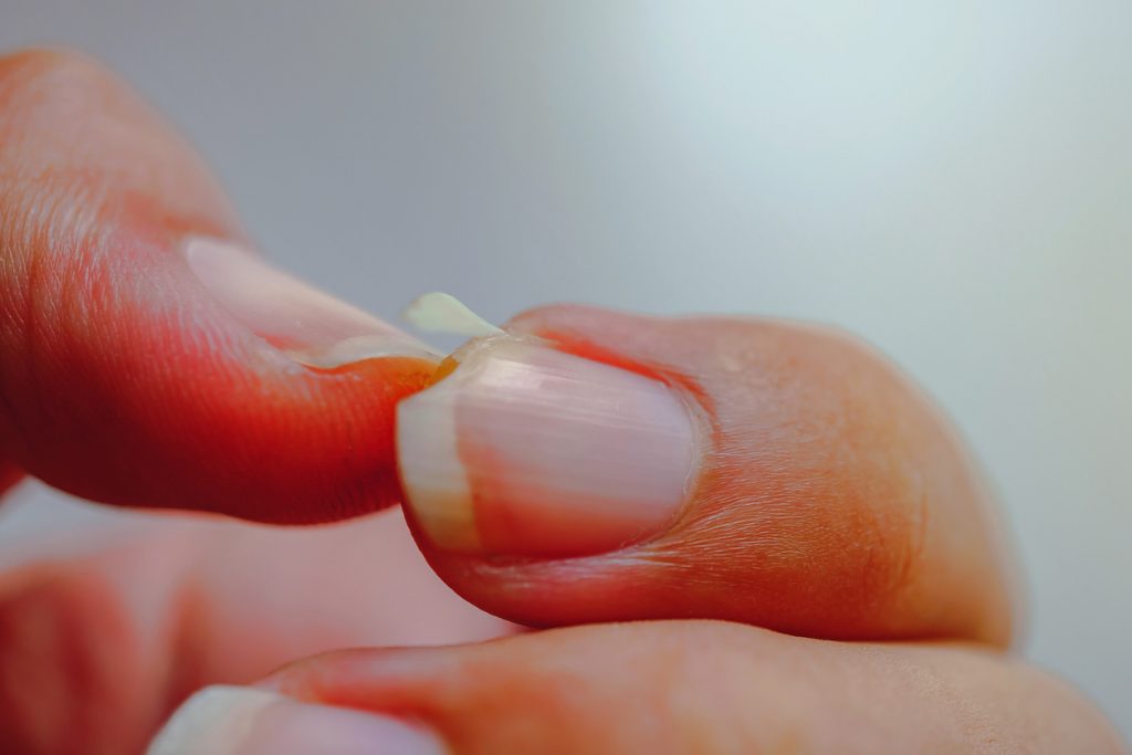 Uñas Quebradizas Y Frágiles