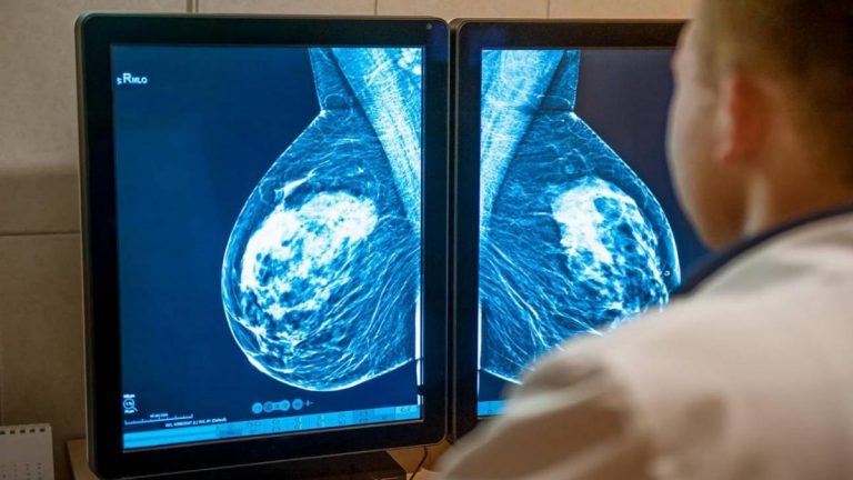 Un gen de las células que rodean los tumores es clave en la progresión del cáncer de mama