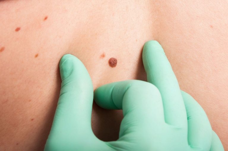Casi el 65% de las muertes por cáncer de piel se atribuyen al melanoma