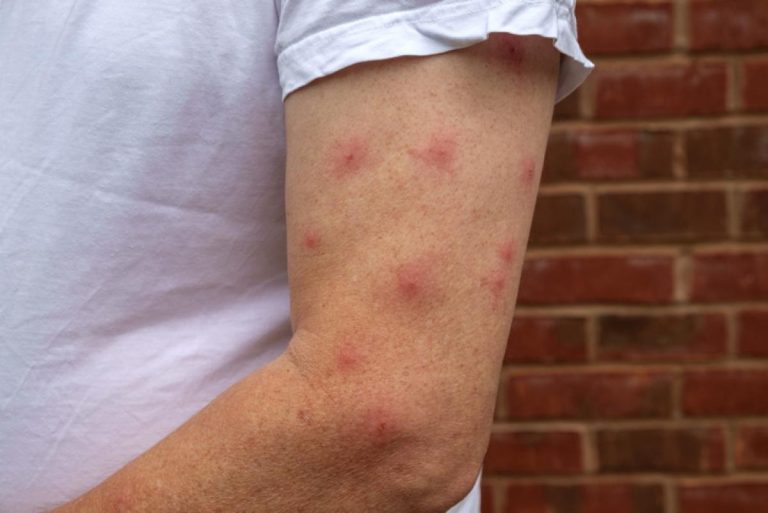 Cómo tratar las picaduras de mosquitos