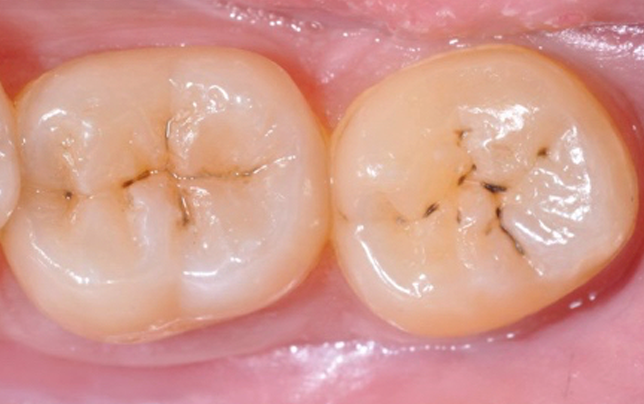 ¿Cómo saber cuándo un diente tiene caries?