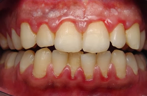 La periodontitis también ocasiona encías inflamadas