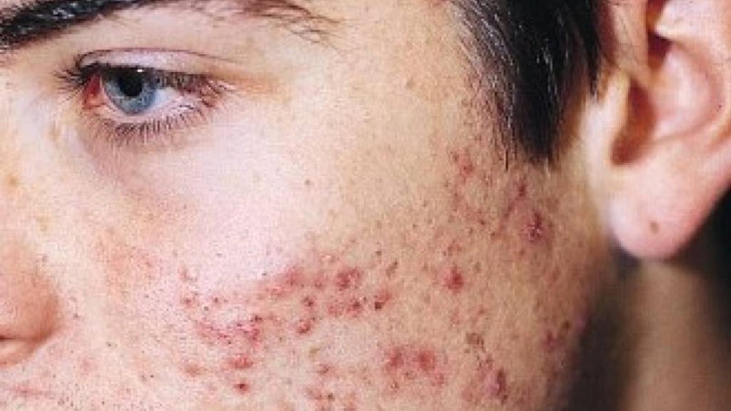 Alimentos Que Causan Acné Y No Dejas De Consumir 5 Consejos Para Evitar La Aparición Del Acné