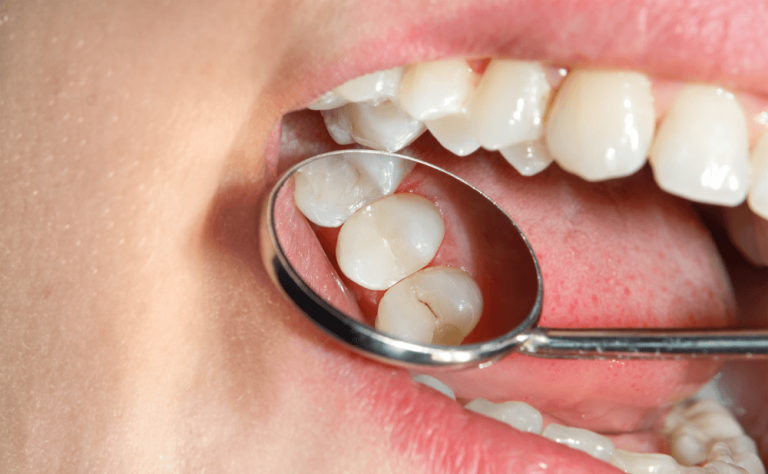 Cómo saber si tienes una caries