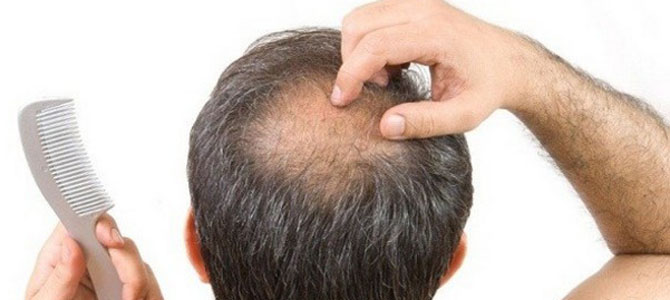 Caída del pelo: causas por las que te puedes quedar calvo