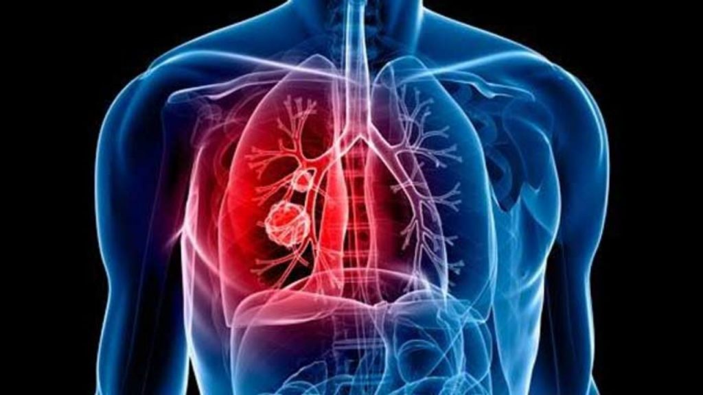 Síndromes causados por el cáncer de pulmón