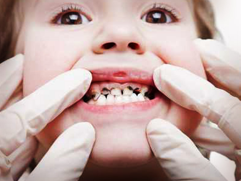 Aumento De Las Caries Y La Aparición De Aftas Bucales Con Frecuencia Dolor De Dientes
