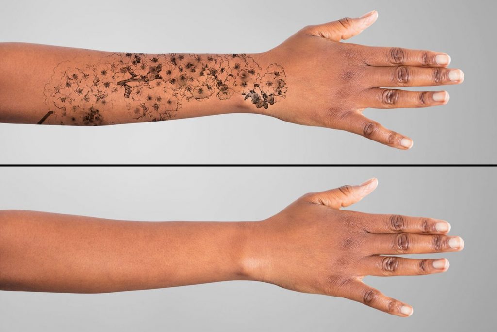 ¿Cómo Retirar Un Tatuaje No Permanente?