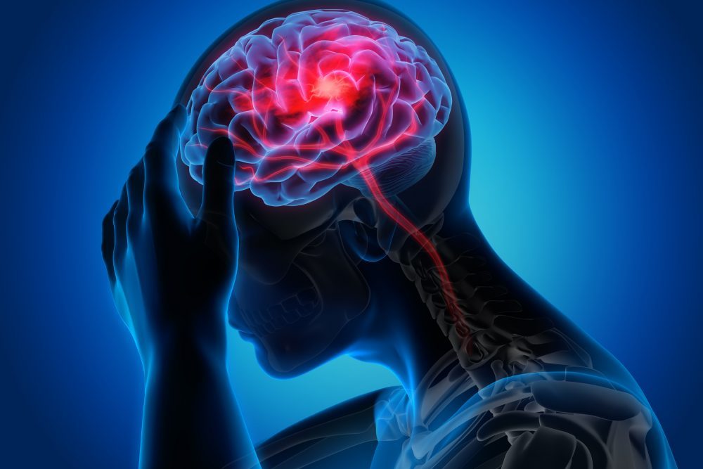 ¿Qué Es La Migraña?