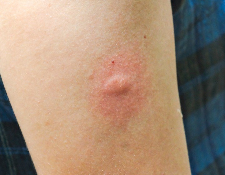 ¿Qué Es Una Picadura De Mosquito?