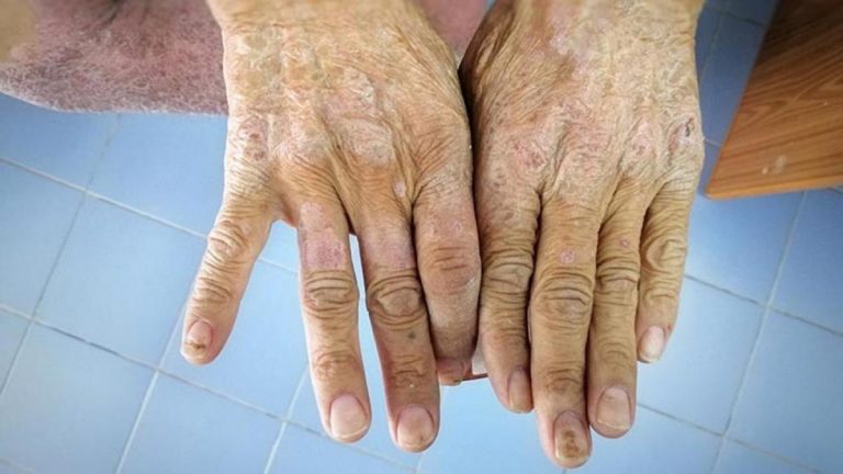 Qué es la esclerodermia