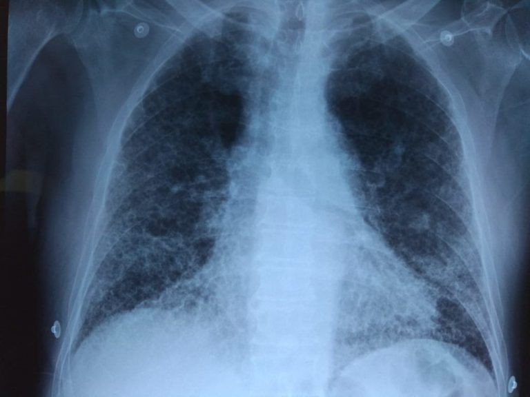 Investigadores muestran la eficacia de la molécula cortistatina para tratar la fibrosis pulmonar