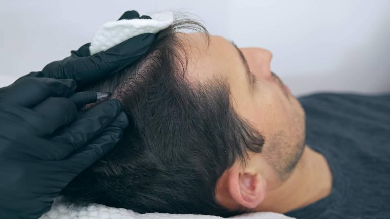 Servicios de micropigmentación capilar de la mano del centro Distrito Wellness Concept