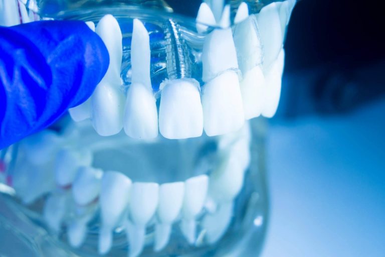 Ahora es posible tener los dientes fijos en un día con la Clínica dental especializada Artydents en Madrid
