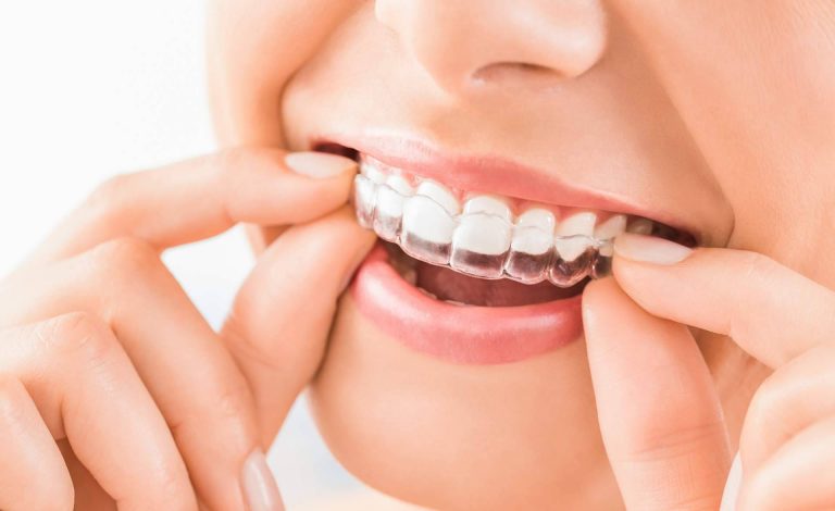 tratamiento de implantes dentales y ortodoncia invisible