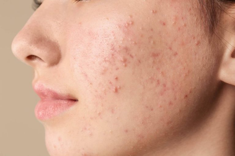 Terminar con las espinillas y el acné es posible actualmente gracias a AcnéXero, una aplicación de inteligencia artificial fundada por dos dermatólogos