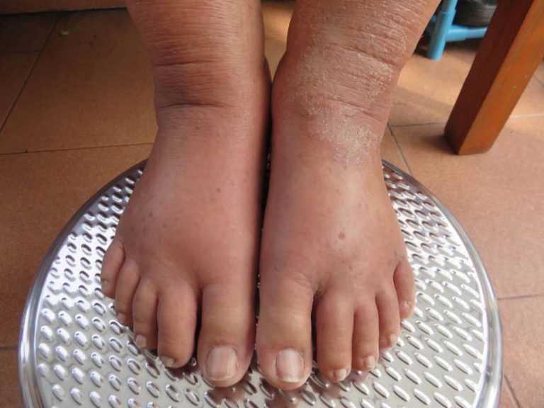 Cómo hacer para bajar la hinchazón de los pies