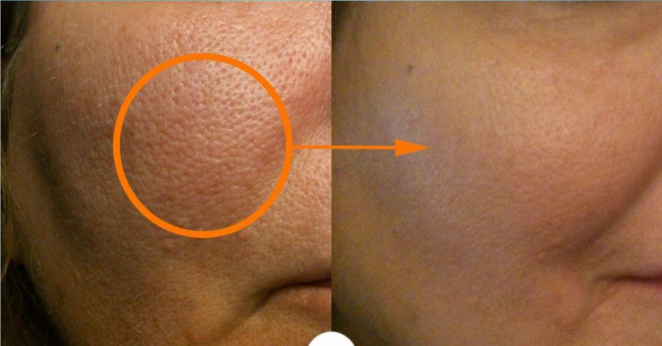 ¿Los poros abiertos de la piel ni se cierran ni se destruyen? Esto es lo que dicen los dermatólogos