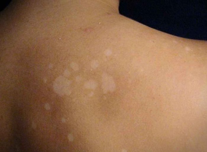 Causas clínicas de las manchas blancas en la piel