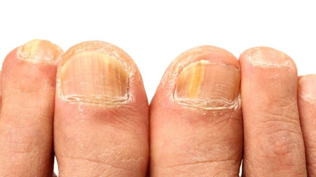 Cómo Deshacerte De Las Uñas Amarillas En Minutos 1 Razones Por Las Que Las Uñas Amarillas Aparecen