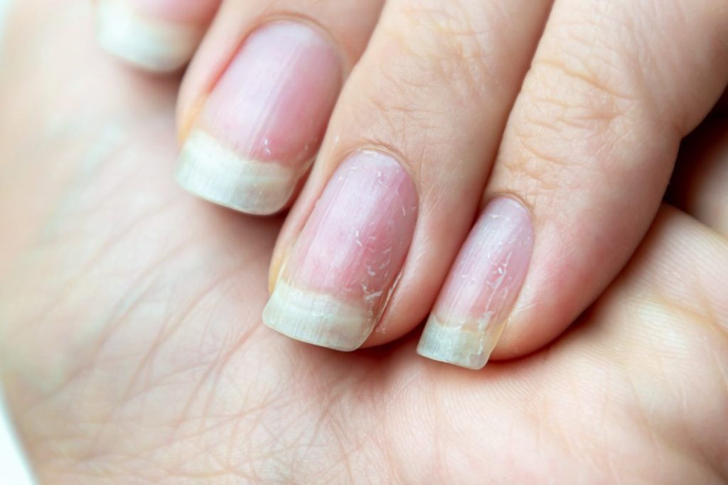 Cómo Deshacerte De Las Uñas Amarillas En Minutos 2 ¿Se Puede Solucionar El Problema De Las Uñas?