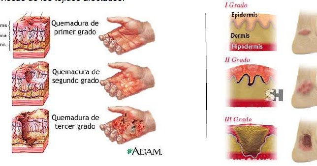 ¿Cuándo Son Quemaduras Peligrosas Y Cuándo Son Leves?