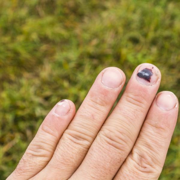 ¿Qué Ocasiona La Aparición De Uñas Moradas?