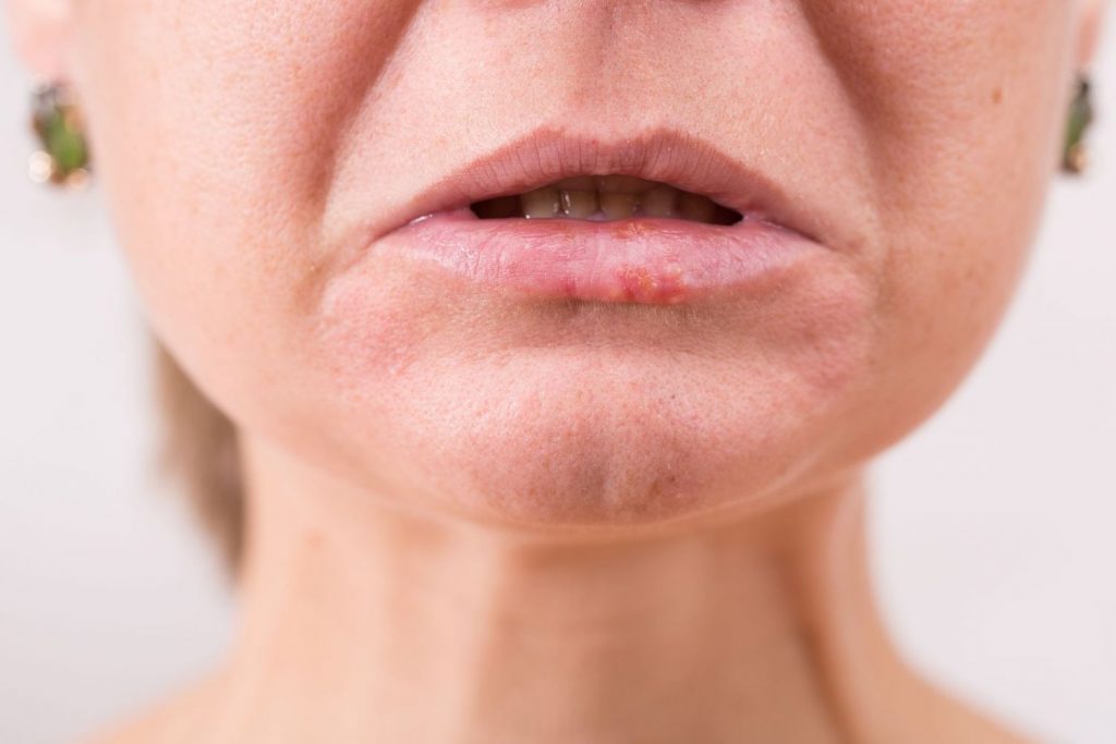 ¿Quiénes Sufren Del Cáncer De Labios Y Por Qué?