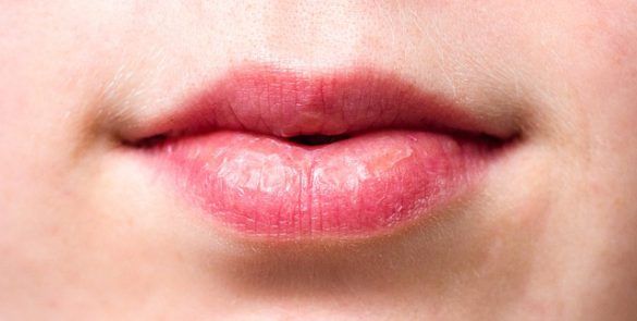 ¿Cómo Se Puede Llegar A Detectar El Cáncer De Labios?