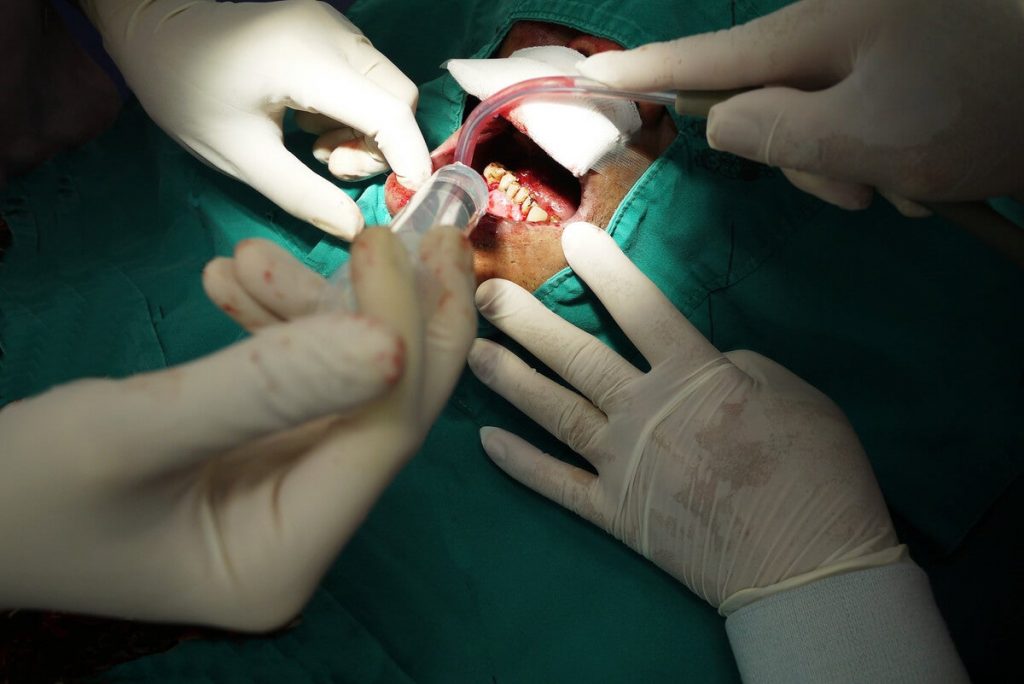 Tratamiento Quirúrgico Para El Cáncer De Labios