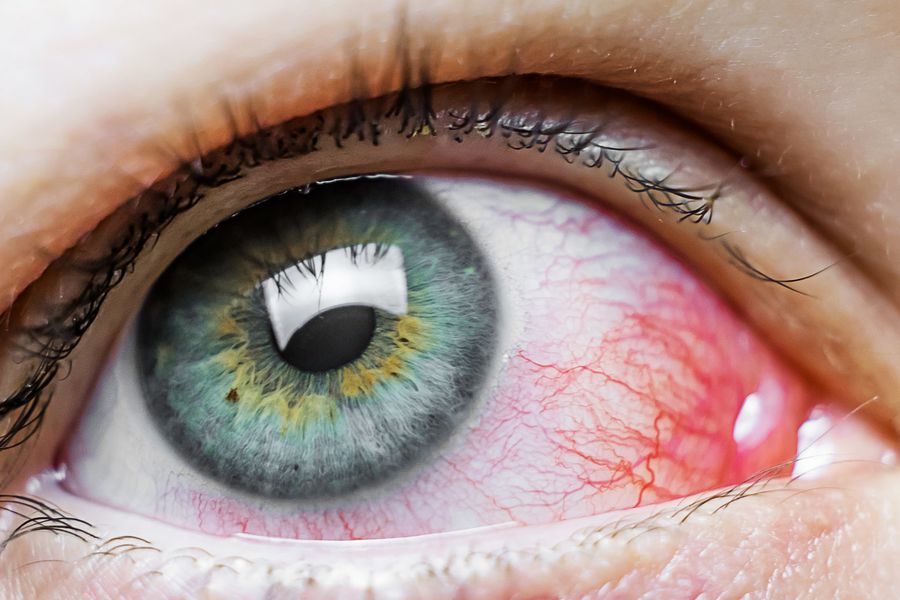 El Coronavirus Podría Detectarse También En Los Ojos