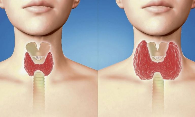 ¿Qué síntomas tiene el cáncer de tiroides?