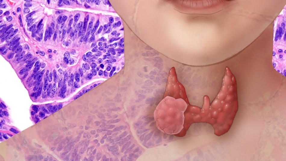 Ilustración del cáncer de tiroides