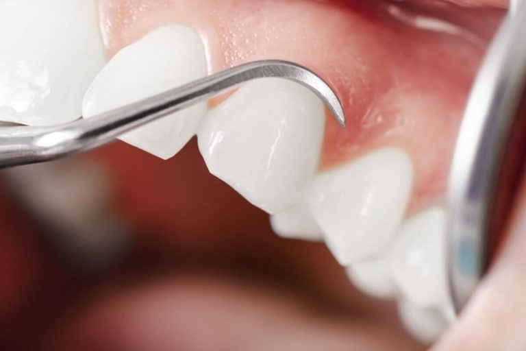 Qué es un raspado dental