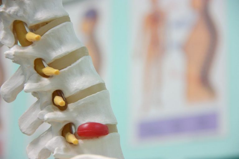 Qué es una protusión discal