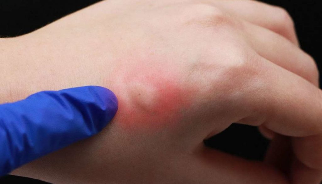 ¿Quiénes sufren de un mayor riesgo a padecer de una reacción alérgica grave a la picadura de mosquitos?