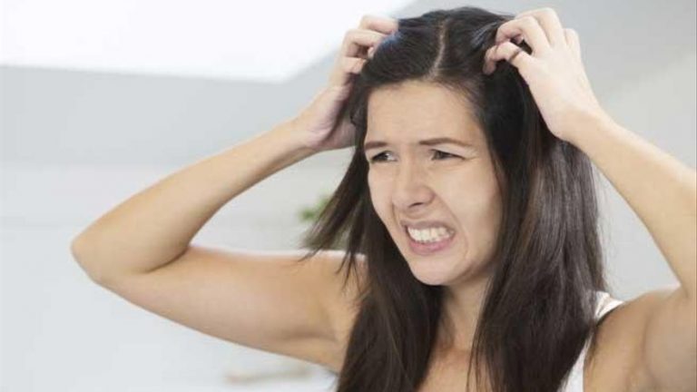 ¿Tienes caspa? Remedios para fulminarla de tu cabeza