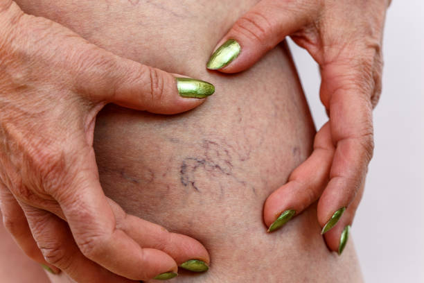 ¿Cómo Evitar Las Varices?