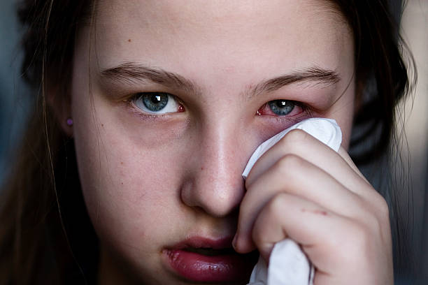 ¿Cómo Saber Si Tengo Conjuntivitis?