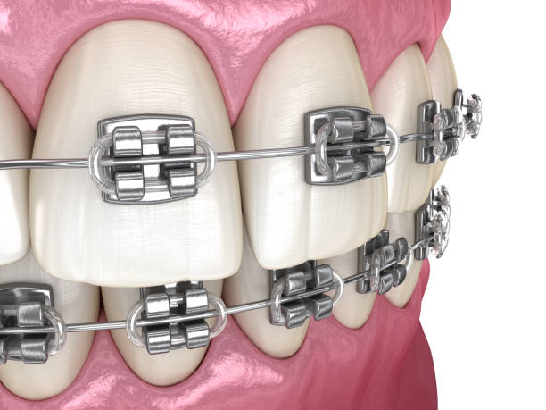 Tipos De Brackets De Acuerdo A Los Signos Que Presente La Persona